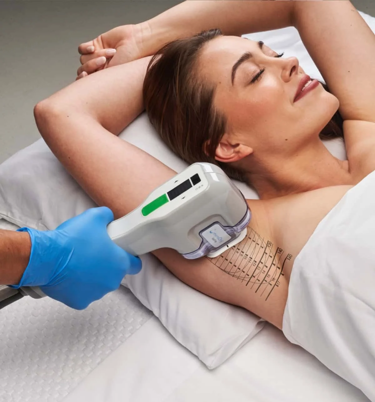 miraDry® (Underarm Sweat & Odor Treatment)