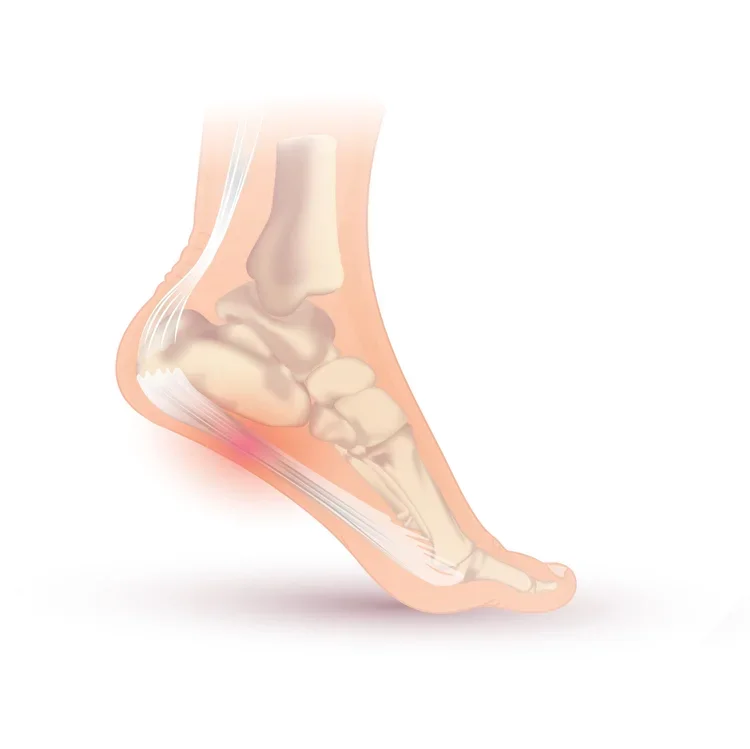 Plantar Fasciitis Towcester