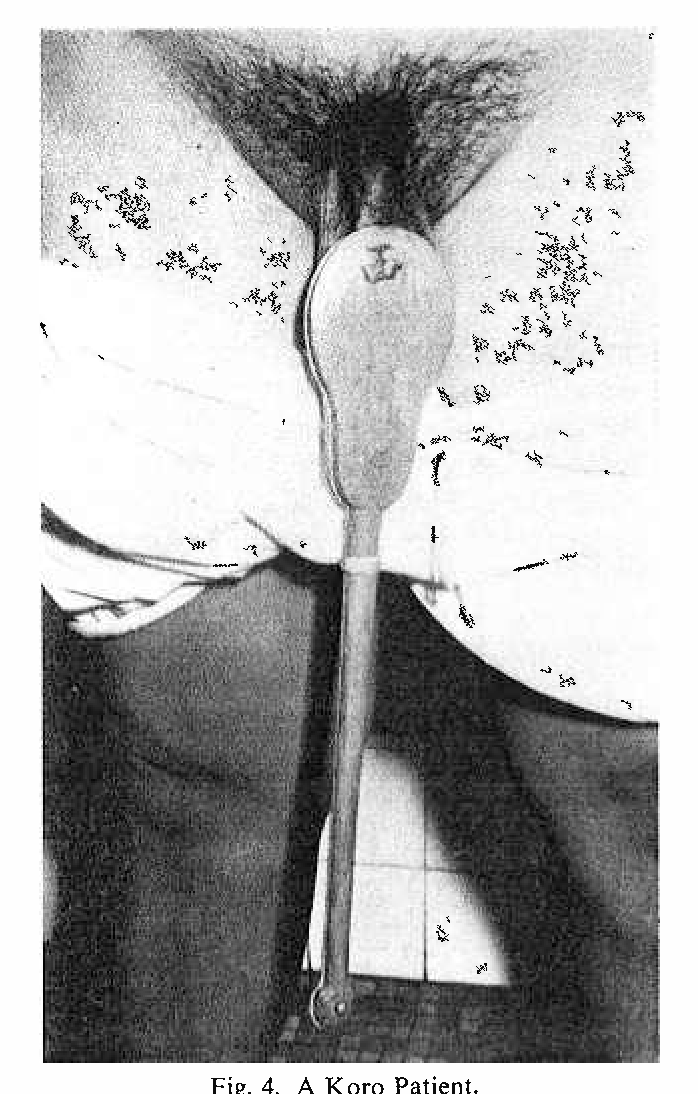 Koro Disease