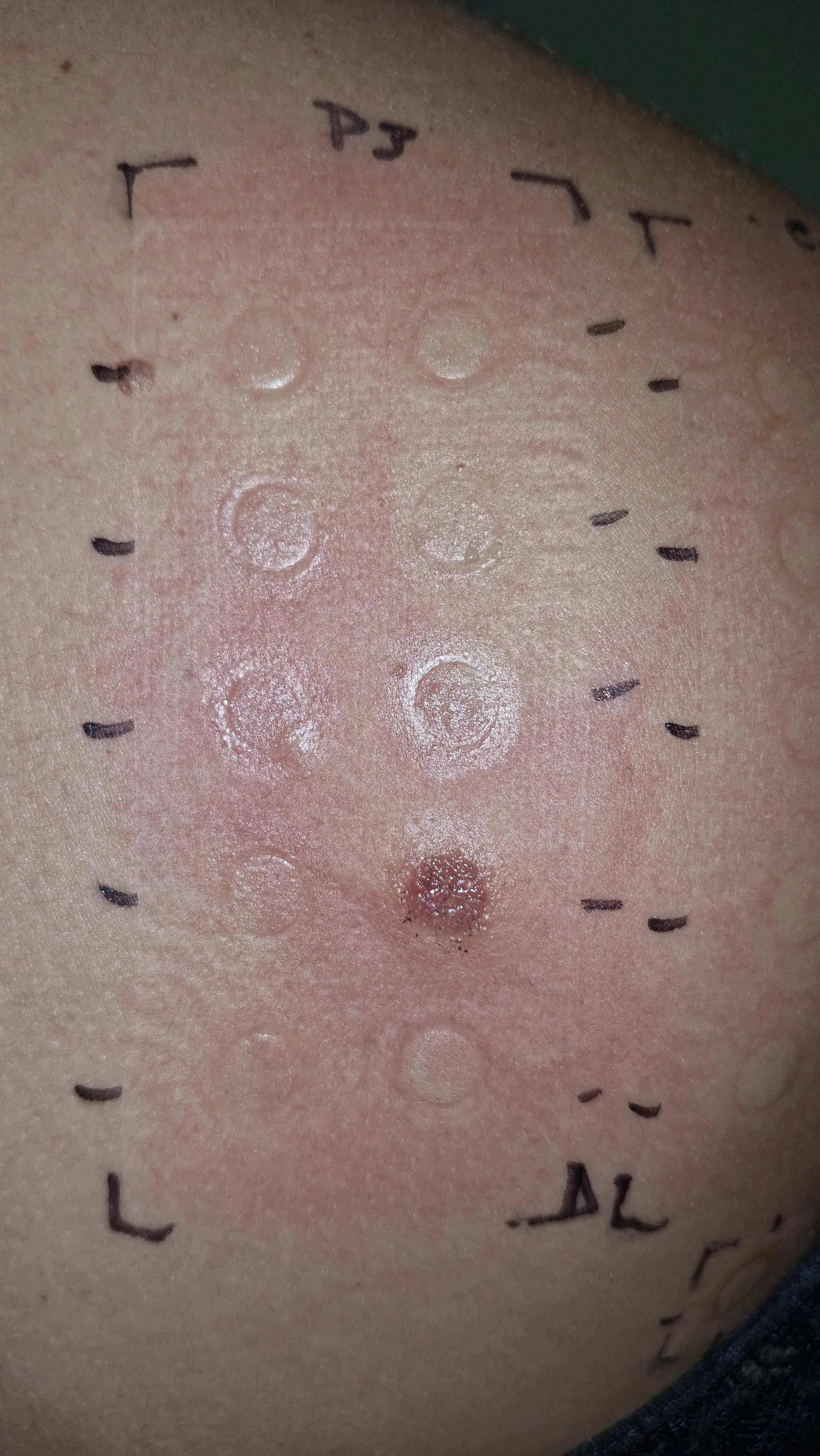 Teste de Alergia