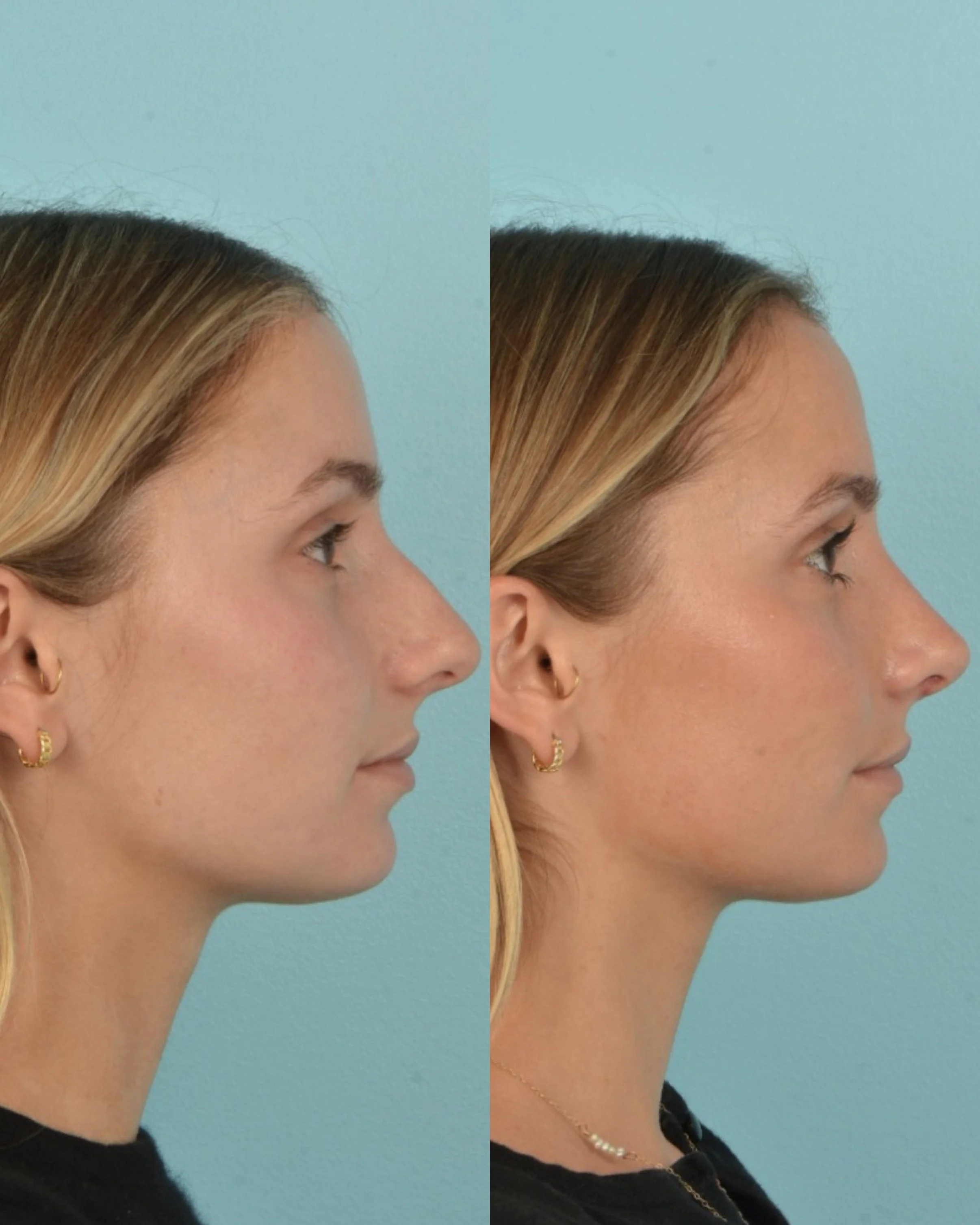 Side-by-side comparison of a woman's profile before and after a cosmetic procedure, showing a noticeable improvement in nasal profile and straightness, with a blue background.