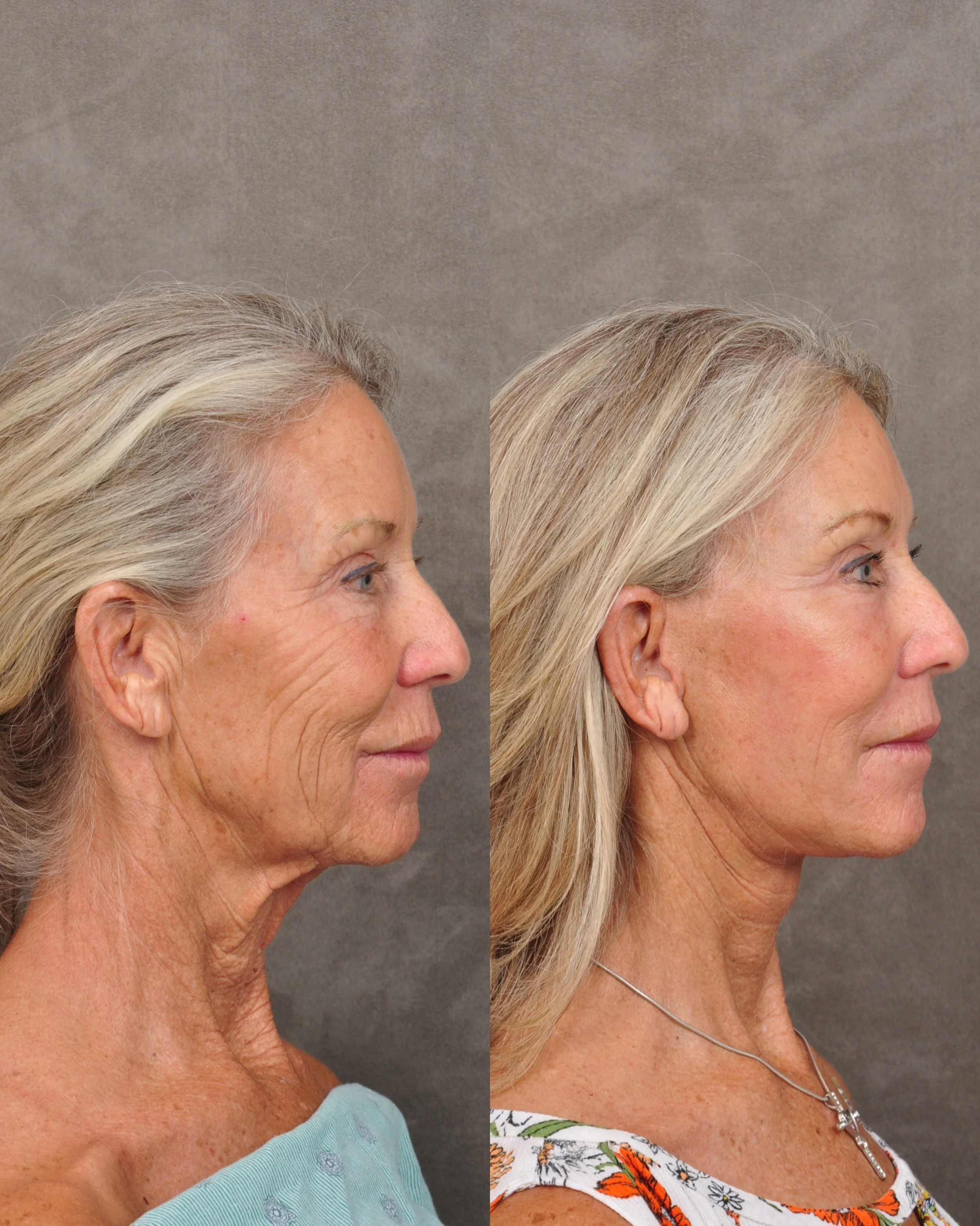 Side-by-side comparison of two women's profiles showing the effects of a cosmetic procedure: the woman on the left has wrinkles and sagging skin, while the woman on the right has smoother skin and a lifted appearance.