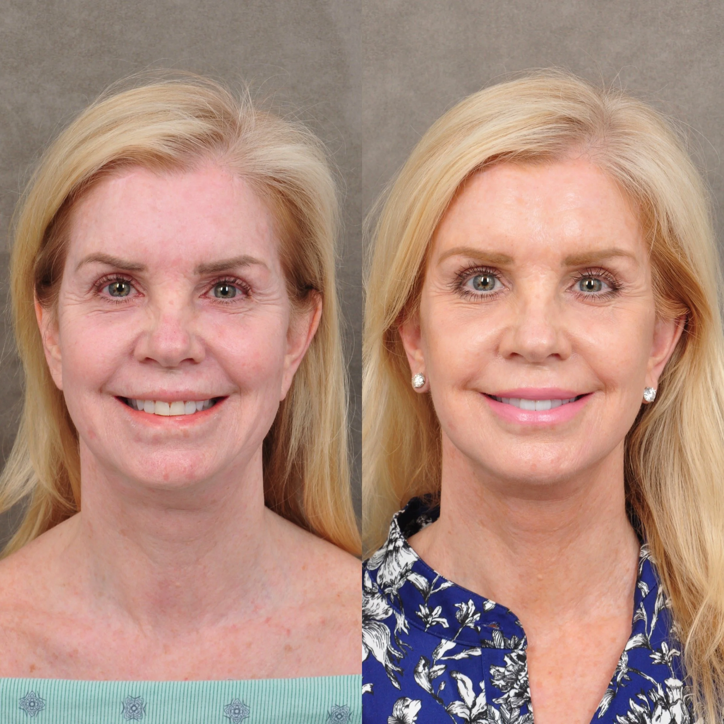 Side-by-side comparison of a woman's face, showing the difference before and after. The left side features a woman with visible signs of aging, uneven skin tone, and wrinkles. The right side shows the same woman with smoother skin, fewer wrinkles, and a more youthful appearance.