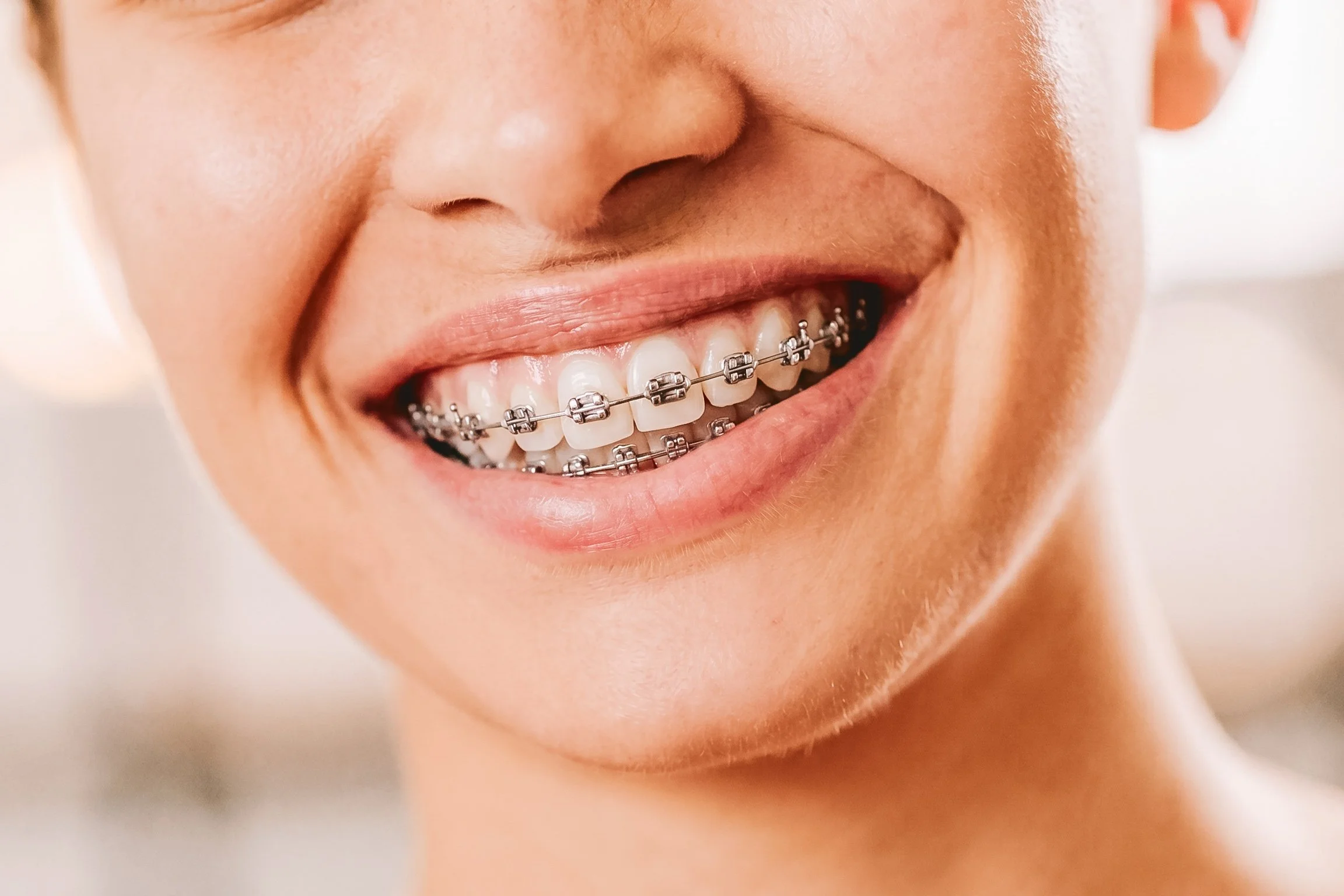 Close-up of a person smiling, showing teeth with braces.