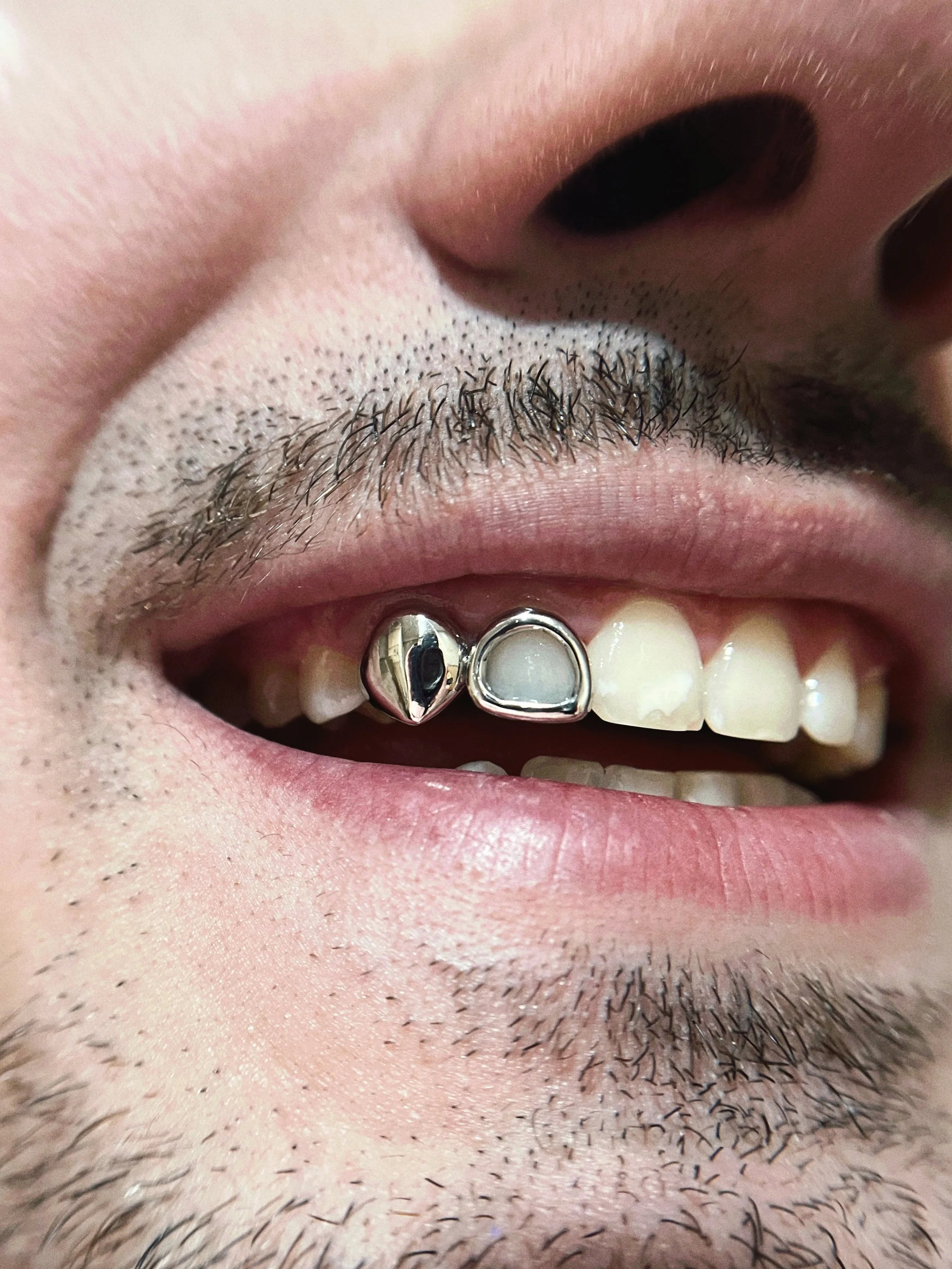 Close-up of a person's mouth with missing upper teeth and a dental implant visible on one side, showing a metallic post and a custom crown.