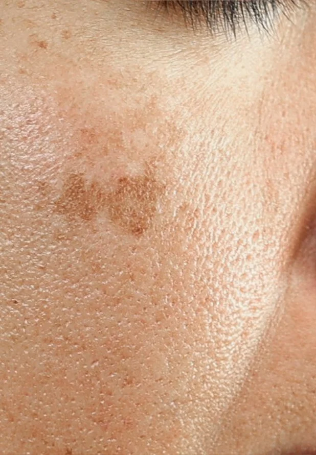 Nahaufnahme von Pigmentstörungen und Altersflecken im Gesicht zur professionellen dermatologischen Diagnose und Behandlung.