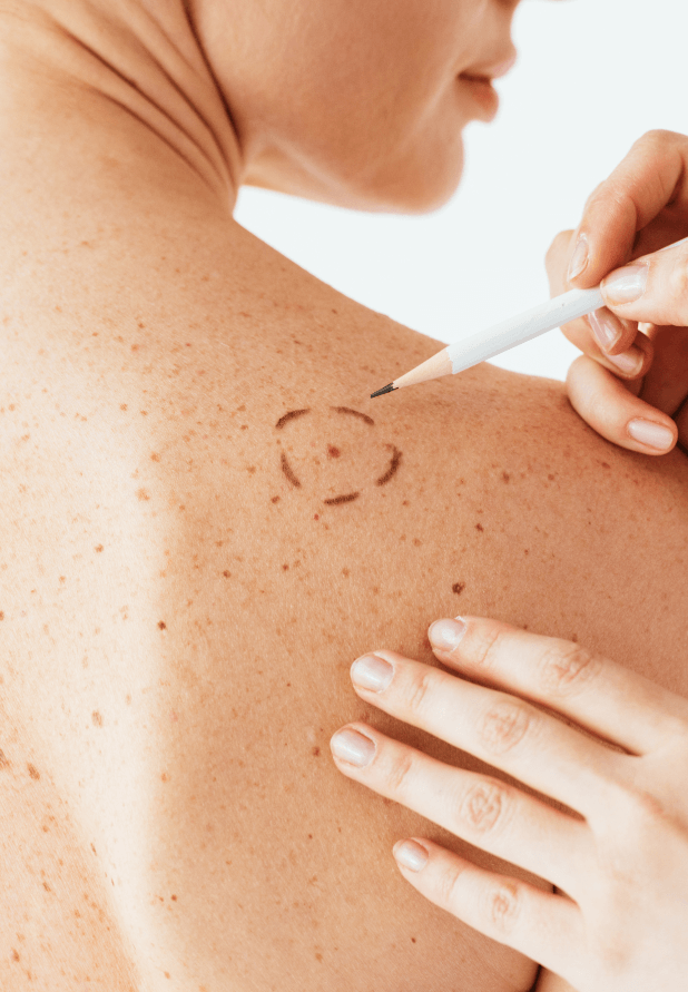 Hautarzt führt eine professionelle Hautkrebsvorsorge mit einem Dermatoskop an der Schulter eines Patienten durch.