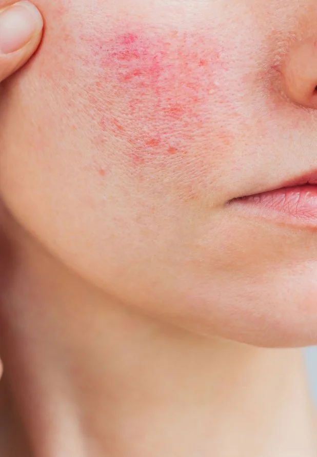 Fachärztliche dermatologische Behandlung von chronischen Rötungen, Couperose und Rosazea im Gesicht.