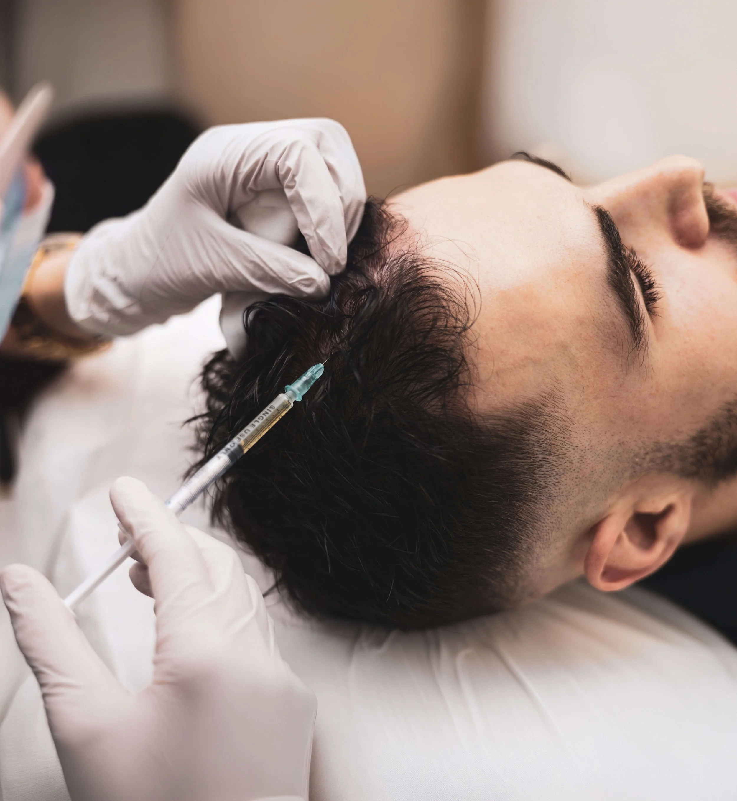 Kopfhautbehandlung gegen Haarausfall mit einer Spritze, zur Haarrekonstruktion oder PRP-Therapie.