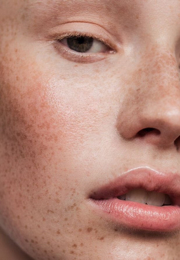 Ästhetische Botox-Behandlung zur Glättung von Mimikfalten für ein natürliches, frisches Aussehen.