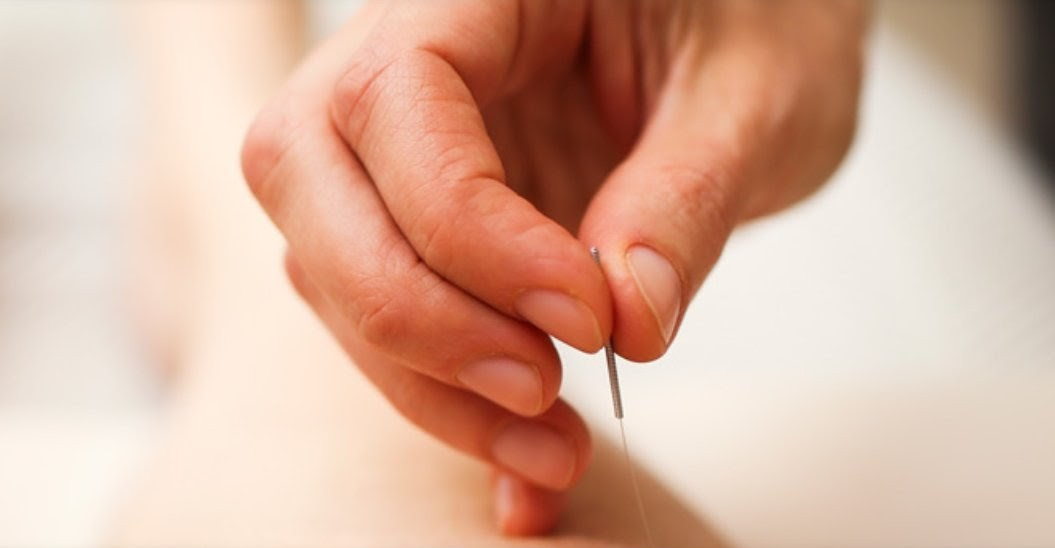 Hands Performing Acupuncture