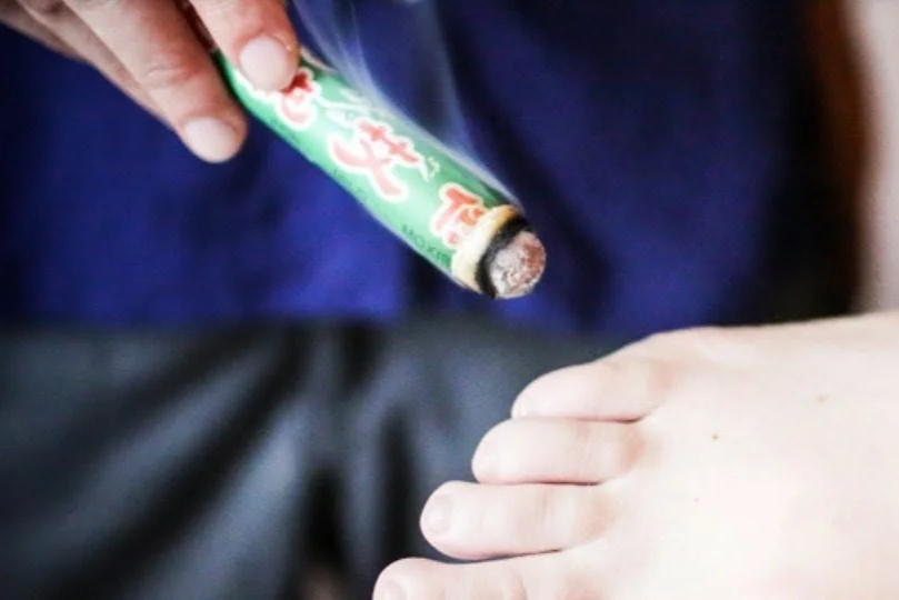 moxa stick used during acupuncture treatment