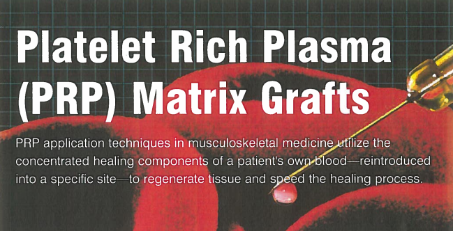 A medical infographic about Platelet Rich Plasma (PRP) Matrix Grafts, including a syringe and a red circular area representing a treatment site.