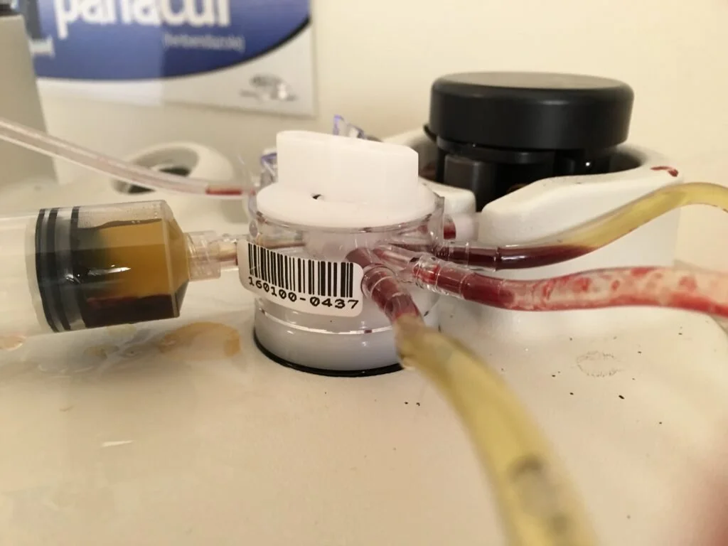 Close-up of a medical device with tubes filled with blood, placed on a white surface, in a clinical setting.