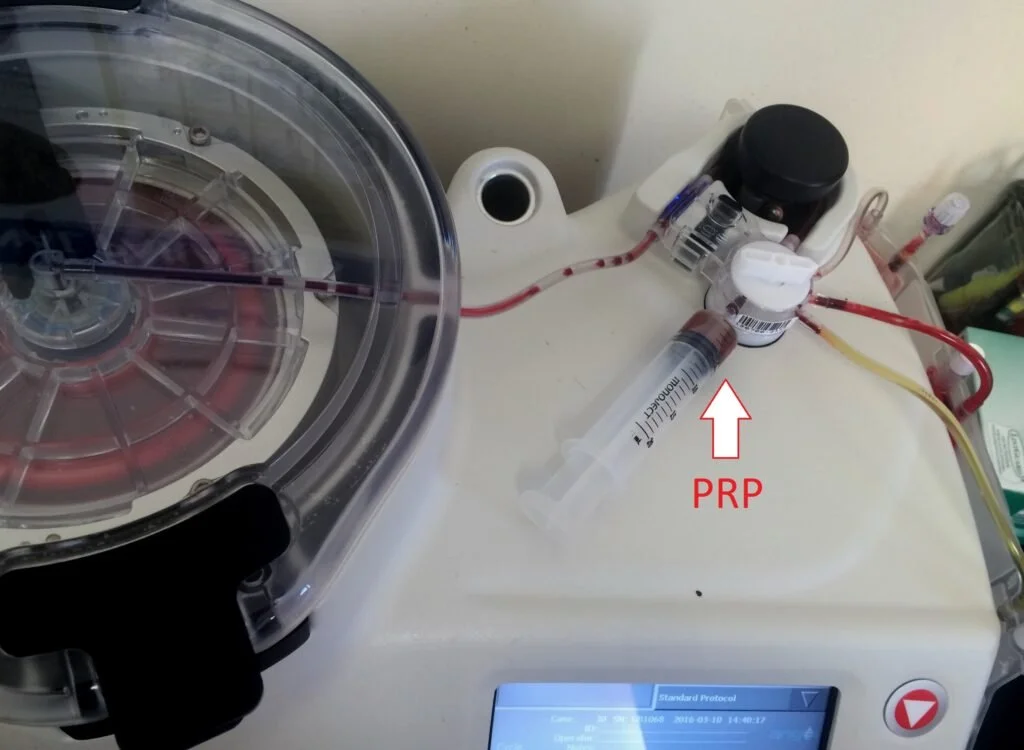 Medical equipment setup with a syringe connected to tubes labeled for PRP (Platelet-Rich Plasma) processing, a centrifuge on the left, and a monitor display at the bottom right corner.