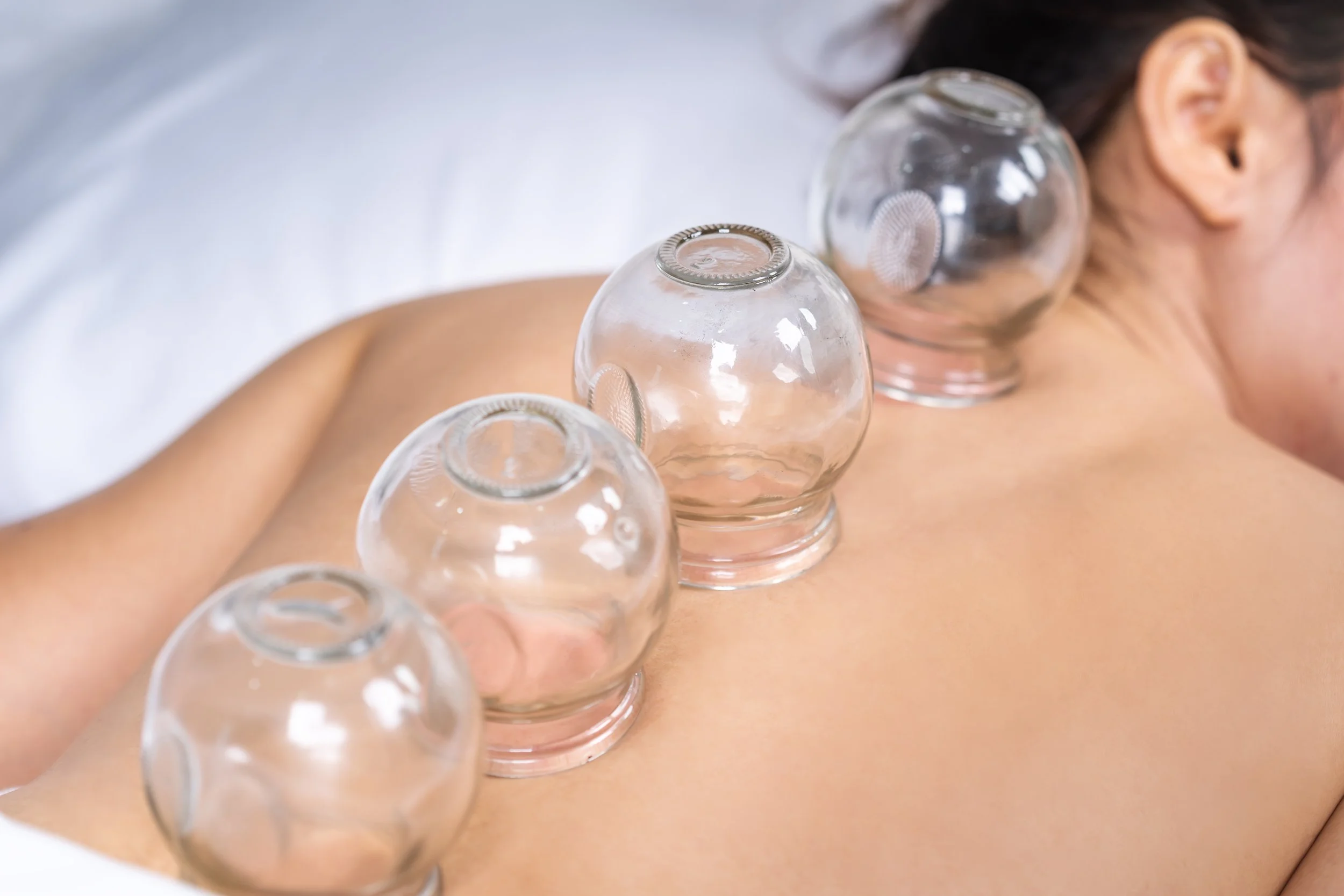 A person receiving a cupping therapy session with glass cups placed on their back.