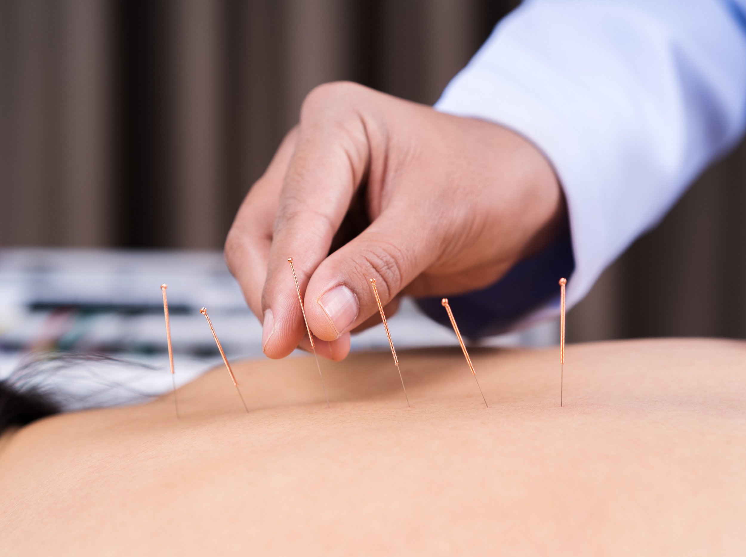 Acupuncture treatment with multiple sterile needles inserted into a patient's back while a practitioner adjusts one needle.