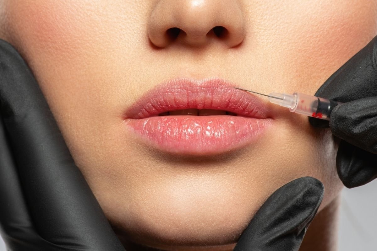 Woman receiving lip fillers.