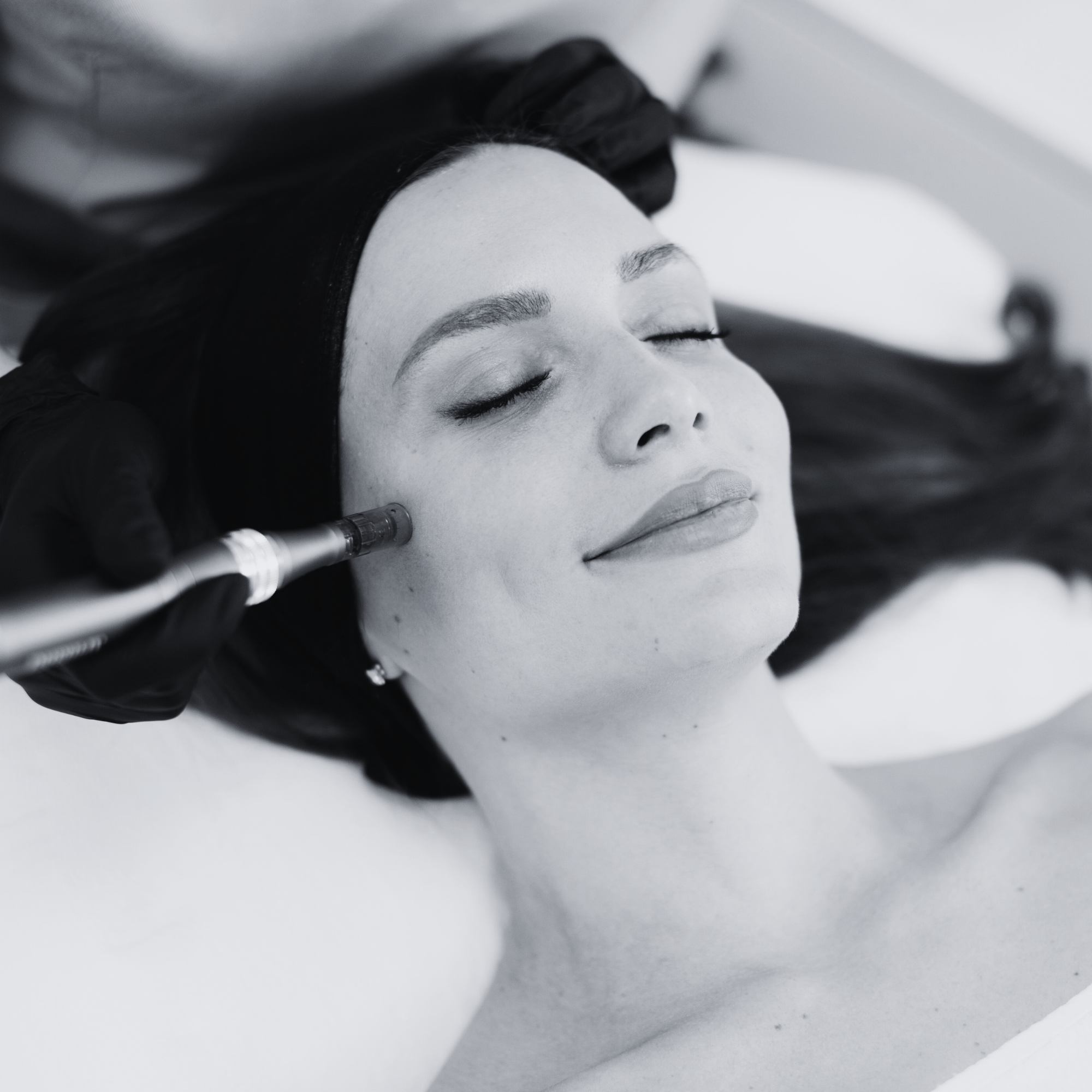 Patient receiving PRF facial treatment for skin rejuvenation