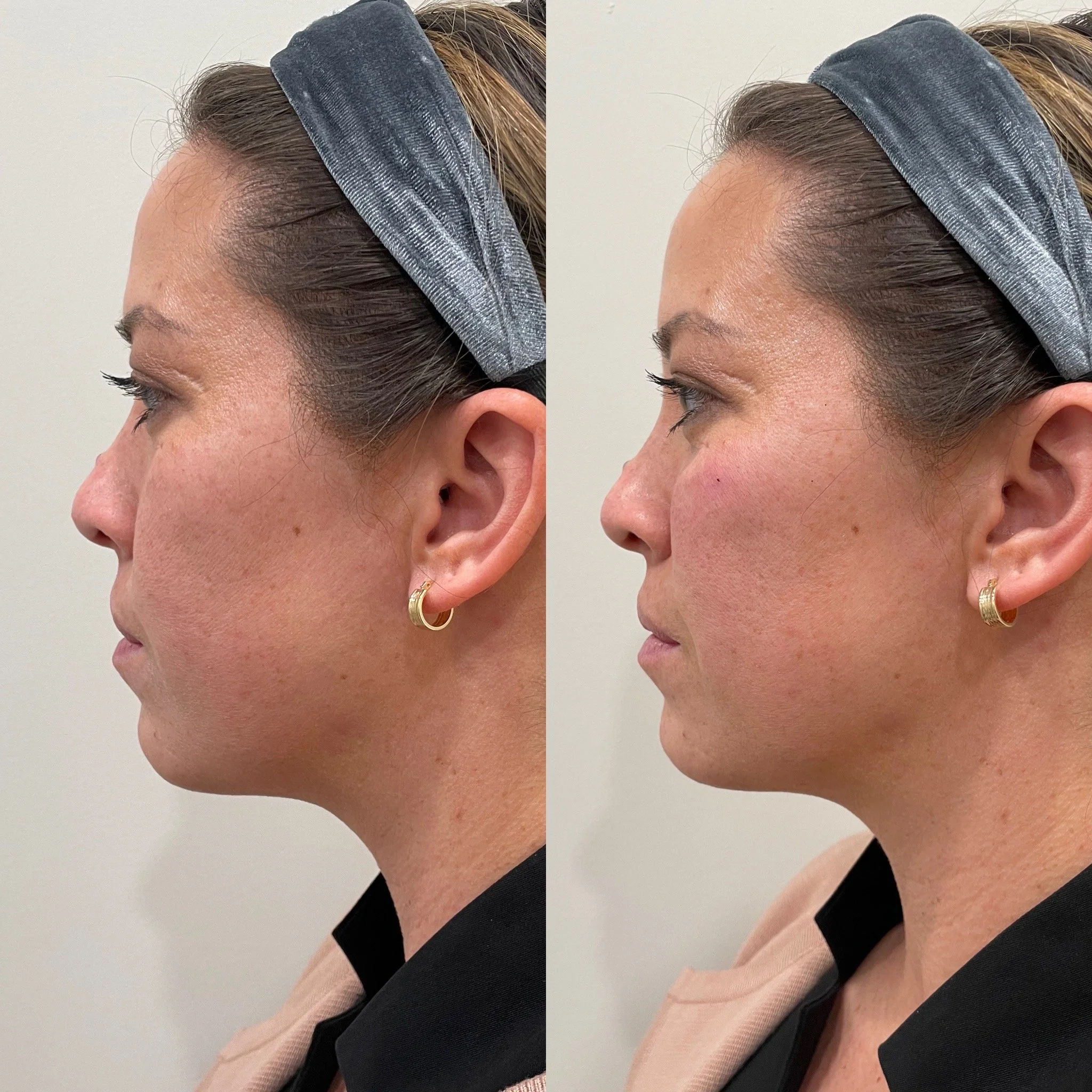 Close-up side profile of a woman's face showing skin before and after a skin treatment, with a gray headband, dark clothing, and small earrings.