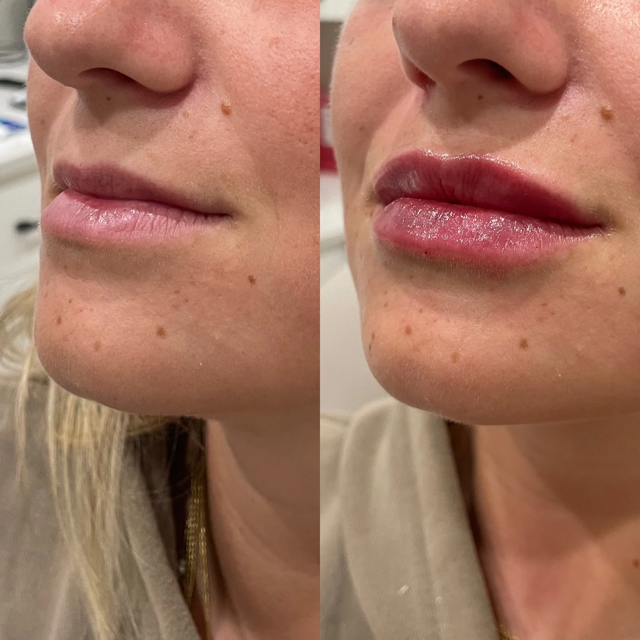 Close-up of a person's face showing their nose, Lips, and a small mole on the right cheek.