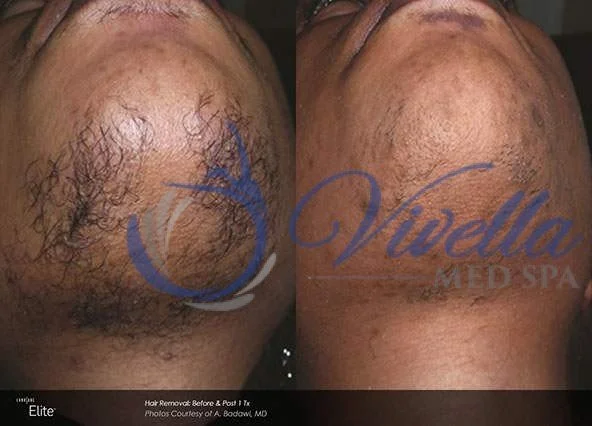 Laser Hair Removal