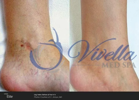Vein Treatments
