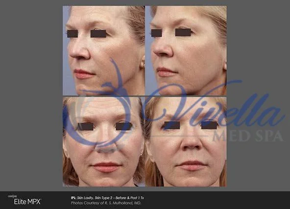 Photorejuvenation