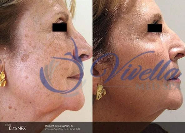 Dark Spot Removal