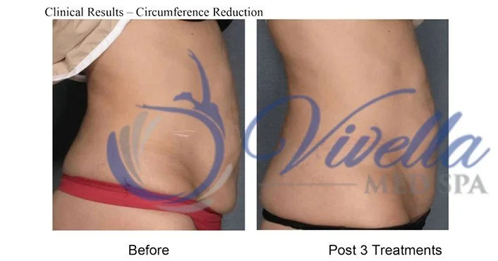 Body Contouring