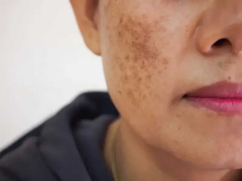 Close-up of a woman's face showing freckles, with part of her lips visible.