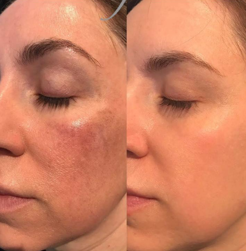 Side-by-side comparison of a woman's face showing skin improvement, with the left side displaying visible hyperpigmentation and uneven skin tone, and the right side showing clear, even-toned skin.