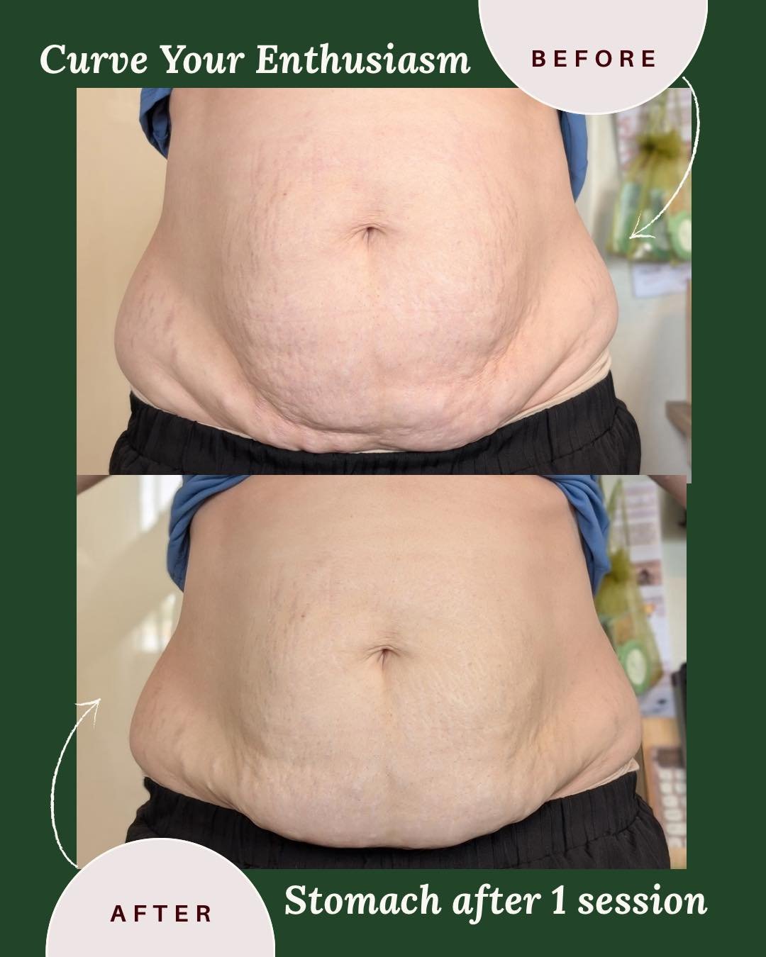 🔥 If this is after ONE session&hellip; imagine what a full treatment series could do.

Take a look at these results after just one Curve Your Enthusiasm treatment on the stomach area.

While everyone&rsquo;s body responds differently, even a single 