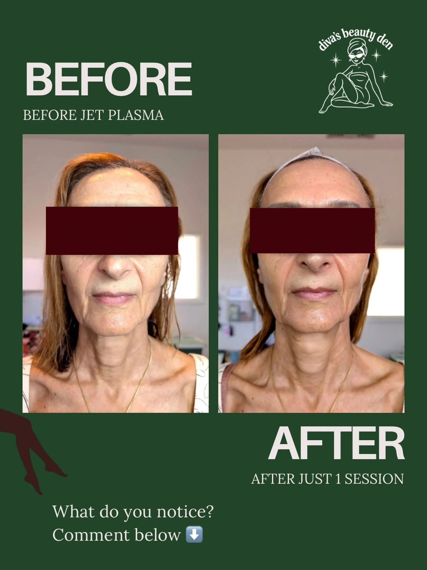 This is a strong before + after, especially after just ONE Jet Plasma session 👀✨

What do you notice first?

For me, it&rsquo;s all about supporting the skin and letting the results build over time. Every client&rsquo;s skin is different, which is w