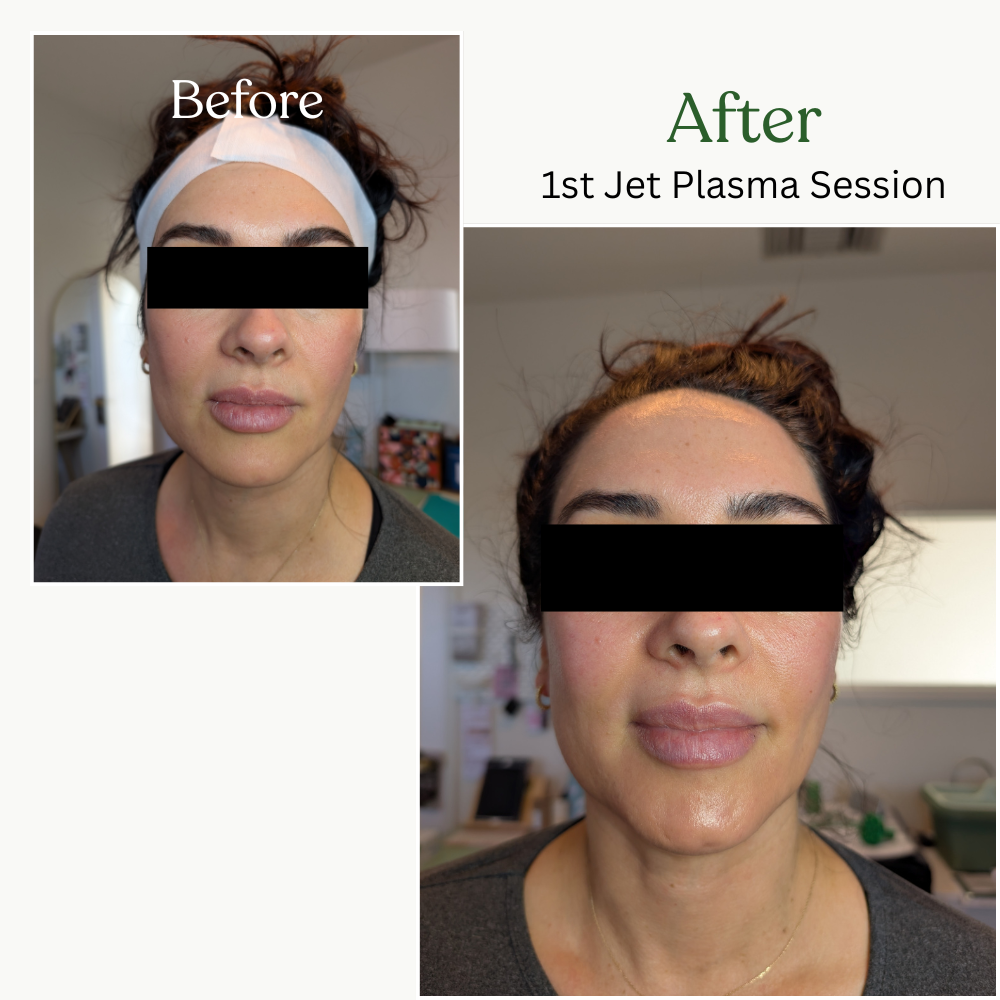 Before and after photos showing the results of a first jet plasma session, with the woman's face indicating improvements in skin appearance.