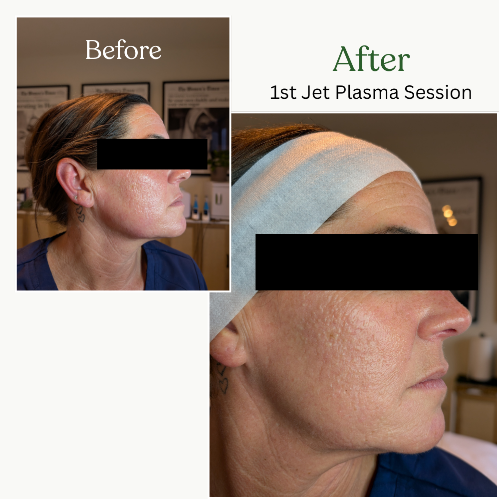 Comparison of a woman's face before and after her first jet plasma session showing skin improvement.
