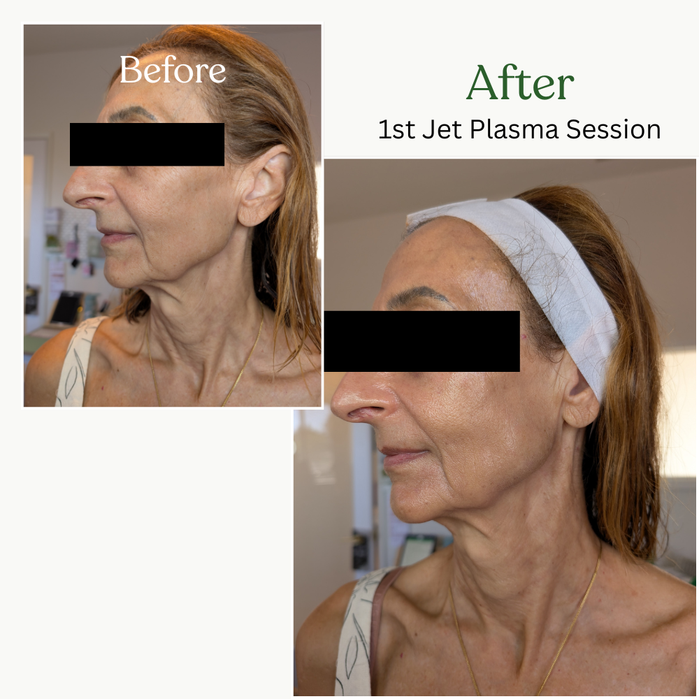 Side-by-side comparison photo of a woman before and after her first Jet Plasma session. In the 'Before' image, her face appears aged with wrinkles and uneven skin texture. In the 'After' image, her skin looks smoother, more even, and rejuvenated, wit