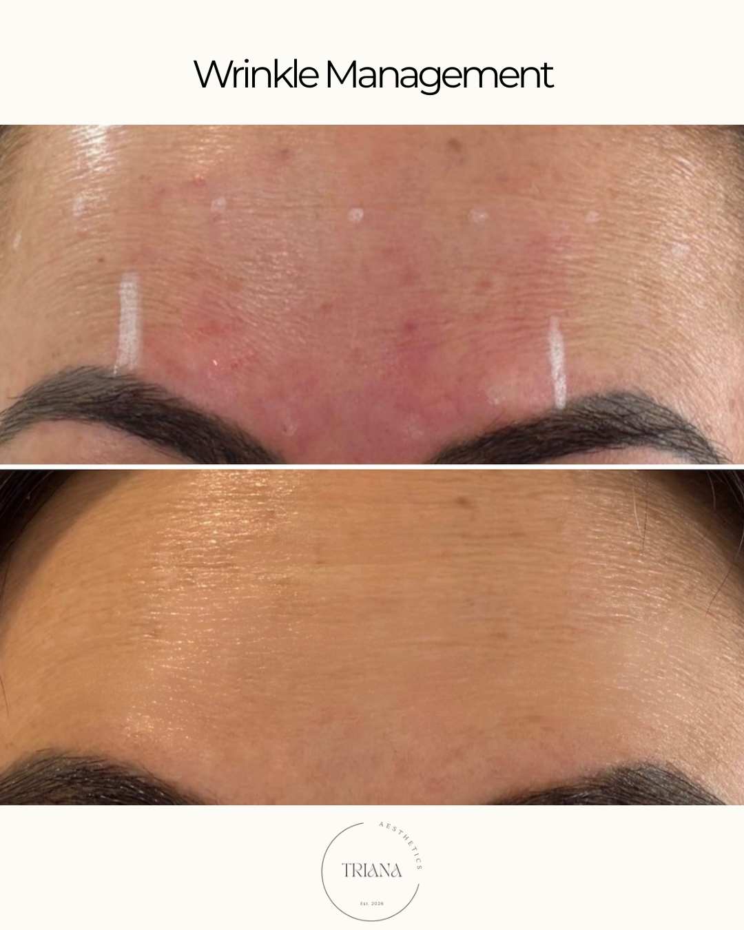 Wrinkle Management - Crow’s Feet.png