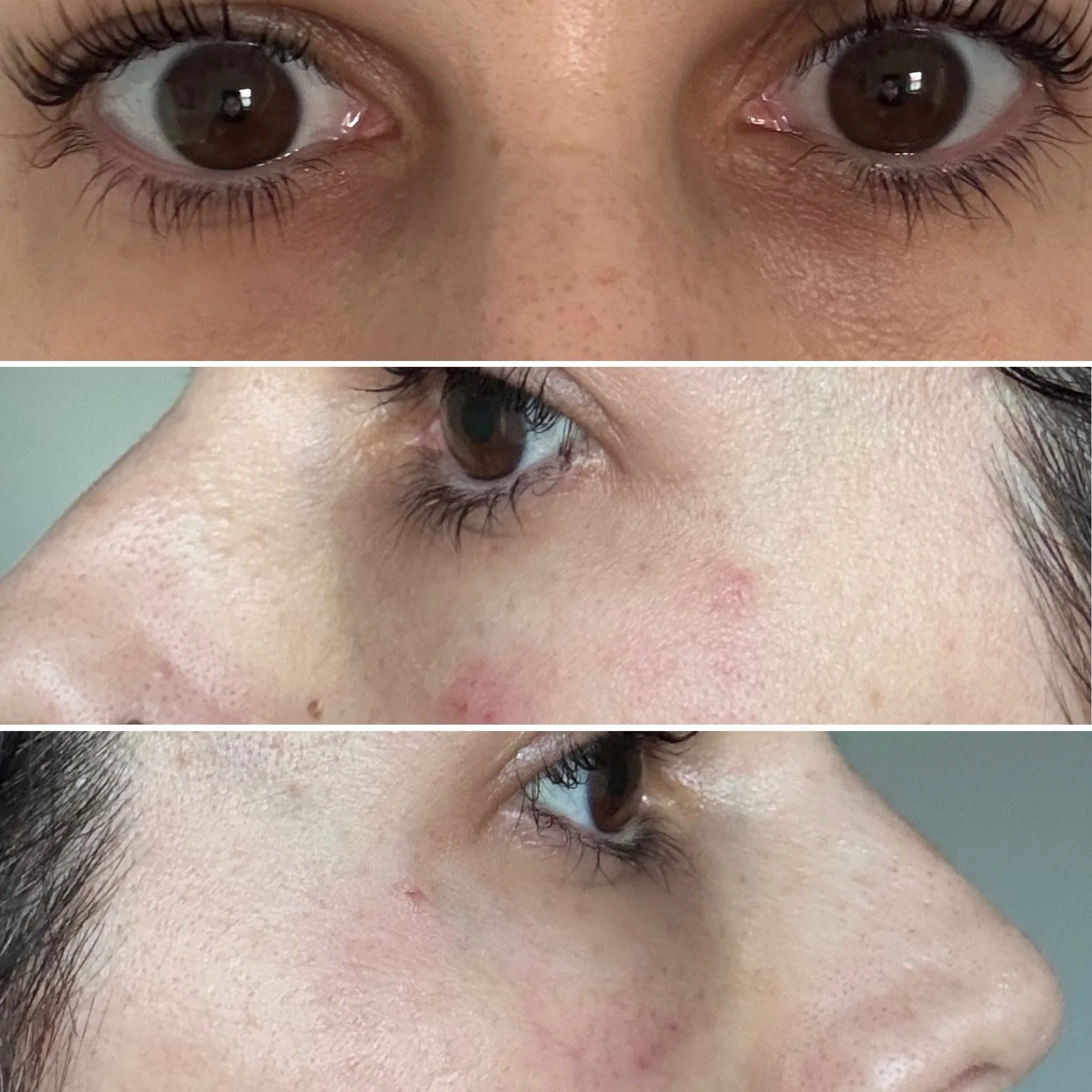 What to expect after your PN under-eye treatment with a cannula :
- slight swelling 
- minor redness or bruising
- minimal tissue trauma 

First picture before, following ones straight after treatment.

What you get after a course of PN:
-Improved Sk