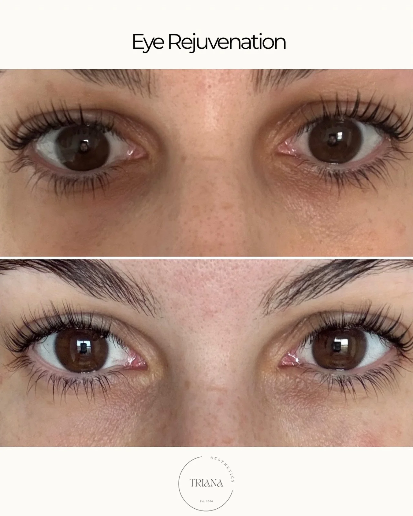 Before above, and after 12 hours post-first session of polynucleotides (PN) for eyes, and the results are already speaking for themselves.

Can&rsquo;t wait to see full results after a 3 course of PN ☺️

Book yours with link in bio