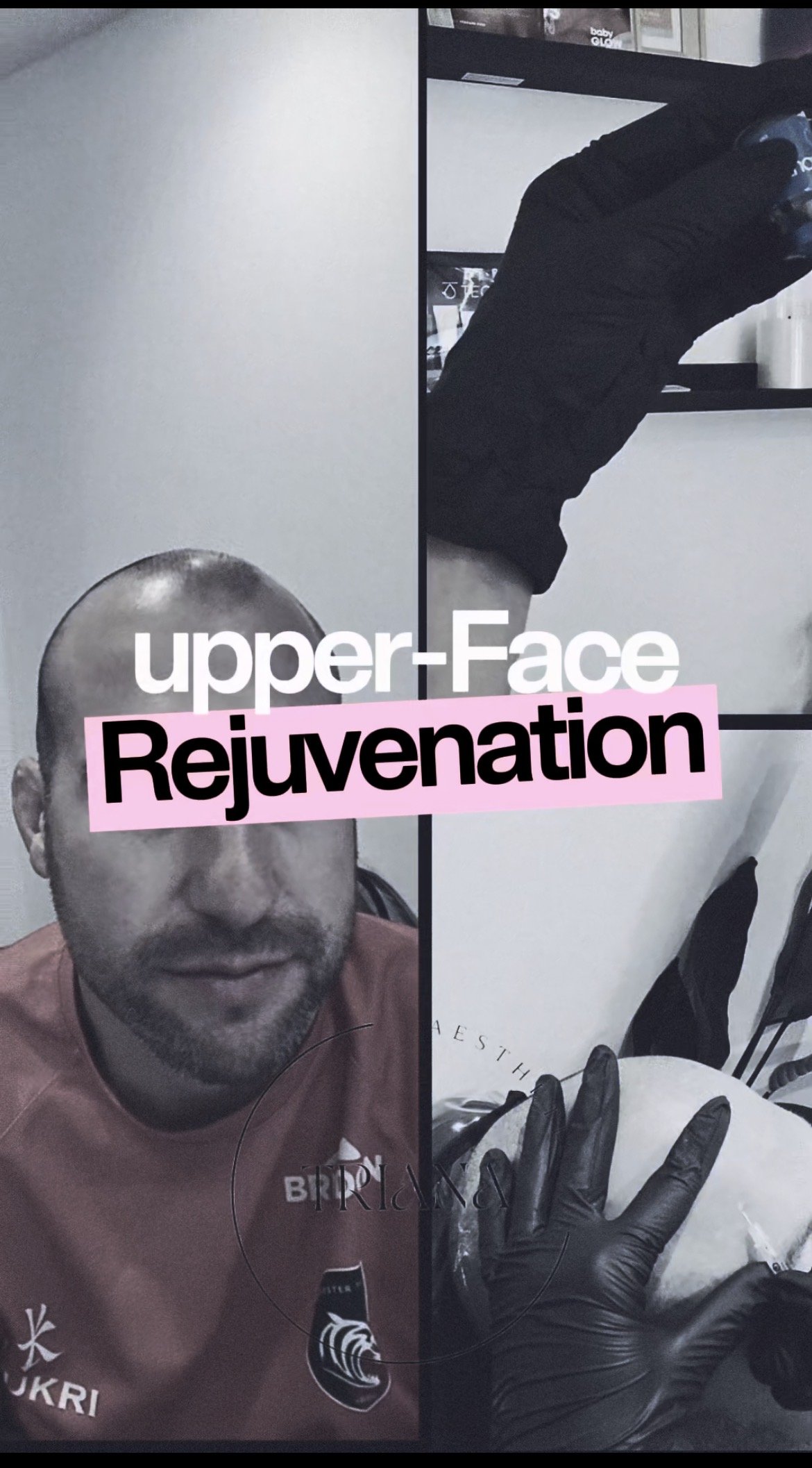A collage of images with the words 'upper-Face Rejuvenation' overlaying the center. The collage features a bald man with facial hair, a person wearing black gloves holding a piece of paper or cloth, and a person receiving a beauty treatment.