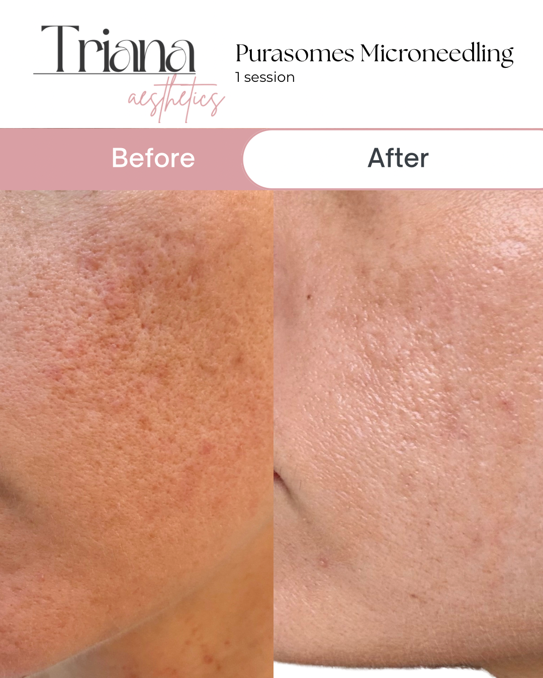 Copy of Copy of Copy of Copy of Copy of Copy of Beige Minimalist Skincare Before and After Instagram Post - 3.png