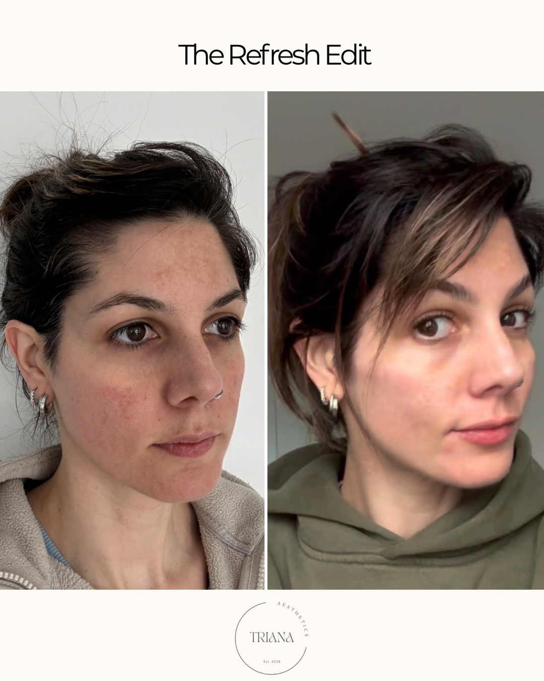 Skin improvement results from 'The Refresh Edit' treatment at Triana Aesthetics, Nuneaton—achieving a radiant and rejuvenated complexion.