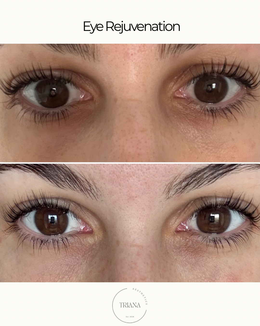 Copy of Wrinkle Management - Crow’s Feet.png