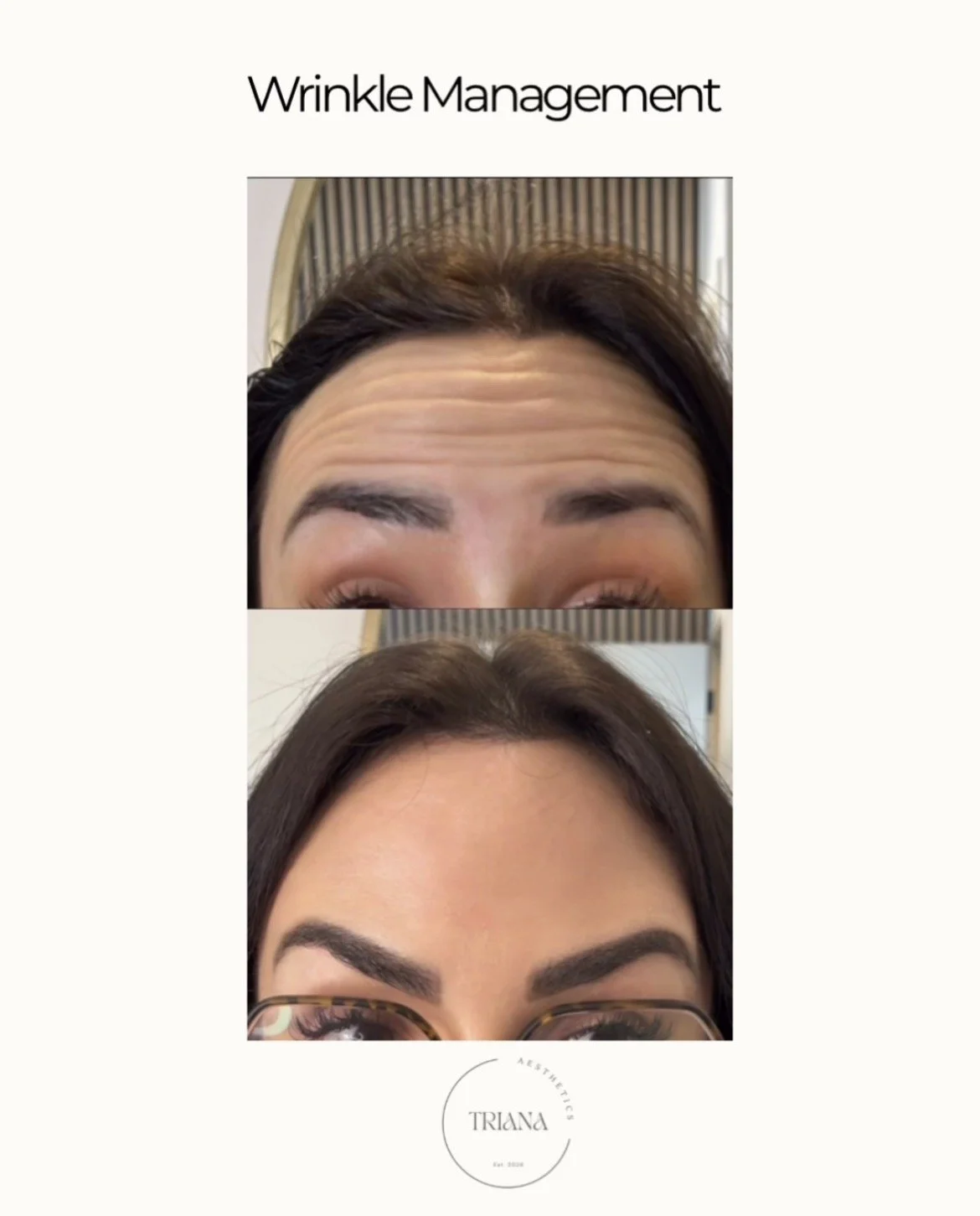 Before and after results of professional wrinkle management treatment at Triana Aesthetics, Nuneaton, showing smooth and natural-looking results.