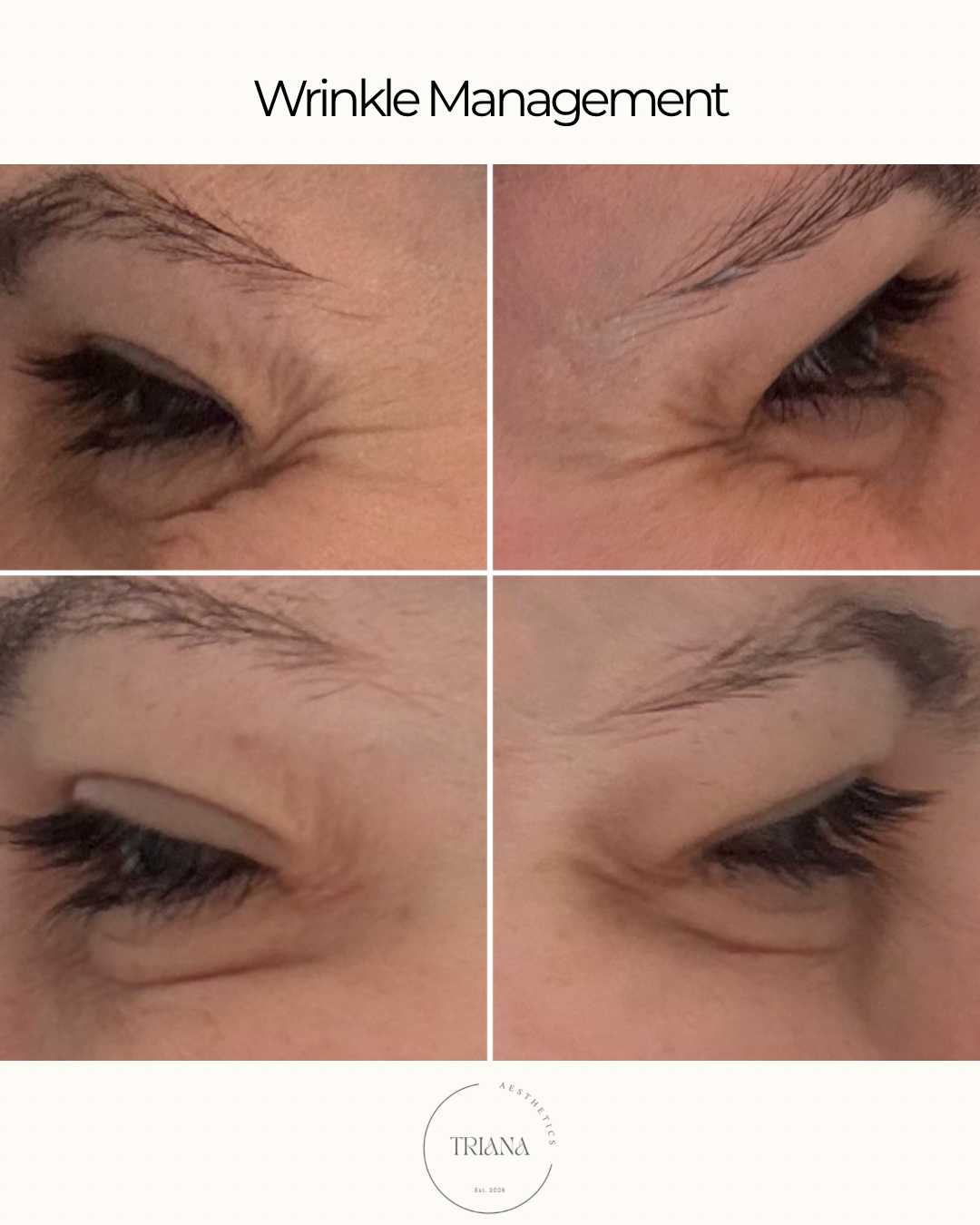 Wrinkle Management - Crow’s Feet.png