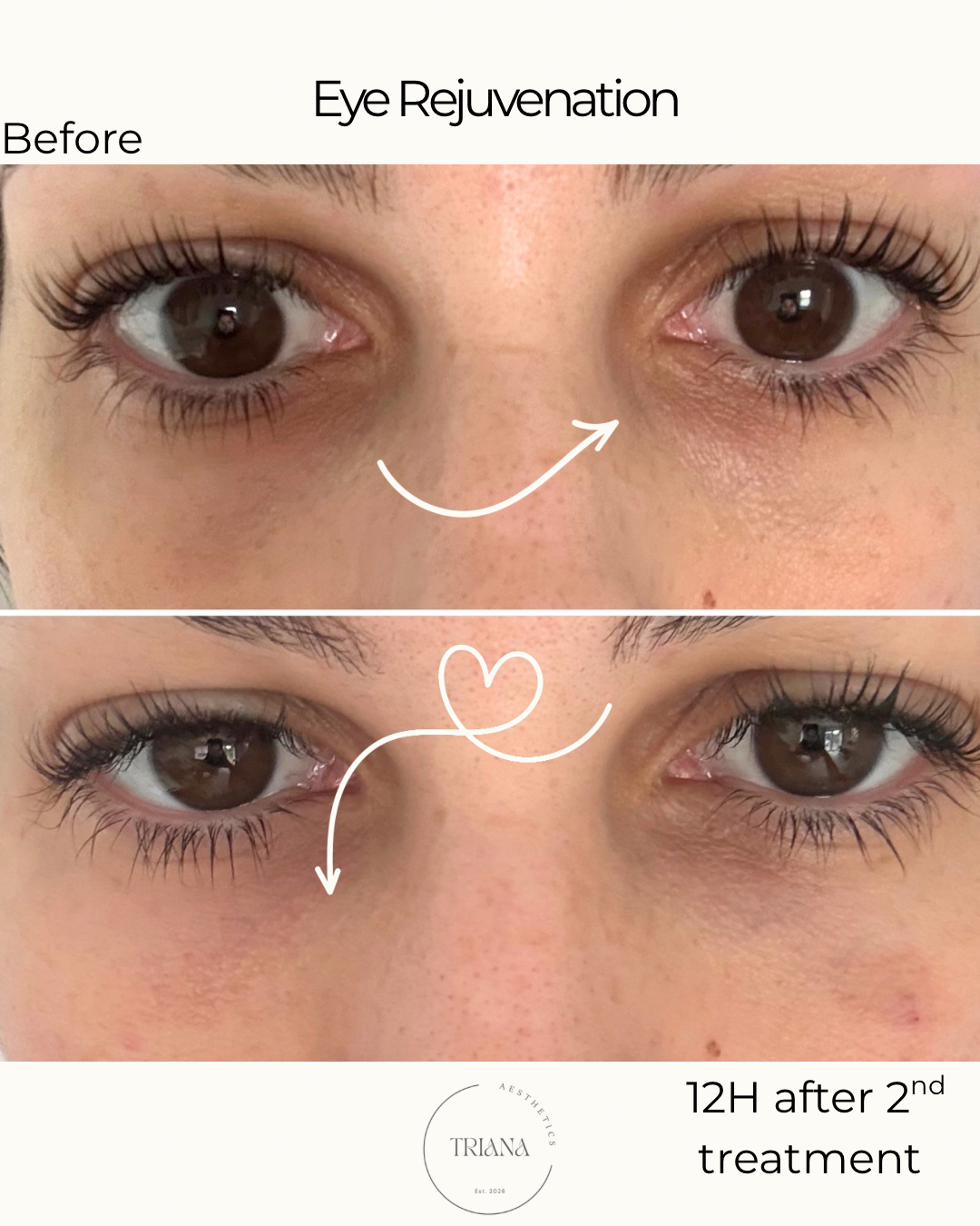 Before and after eye rejuvenation treatment results at Triana Aesthetics, Nuneaton, showcasing reduced puffiness and a refreshed appearance.
