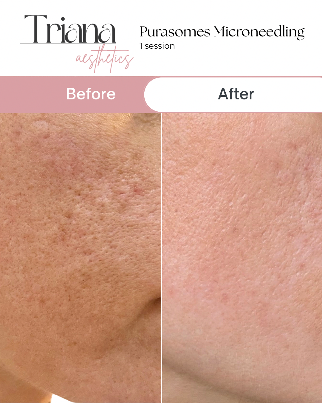 Copy of Copy of Copy of Copy of Copy of Copy of Beige Minimalist Skincare Before and After Instagram Post - 1.png