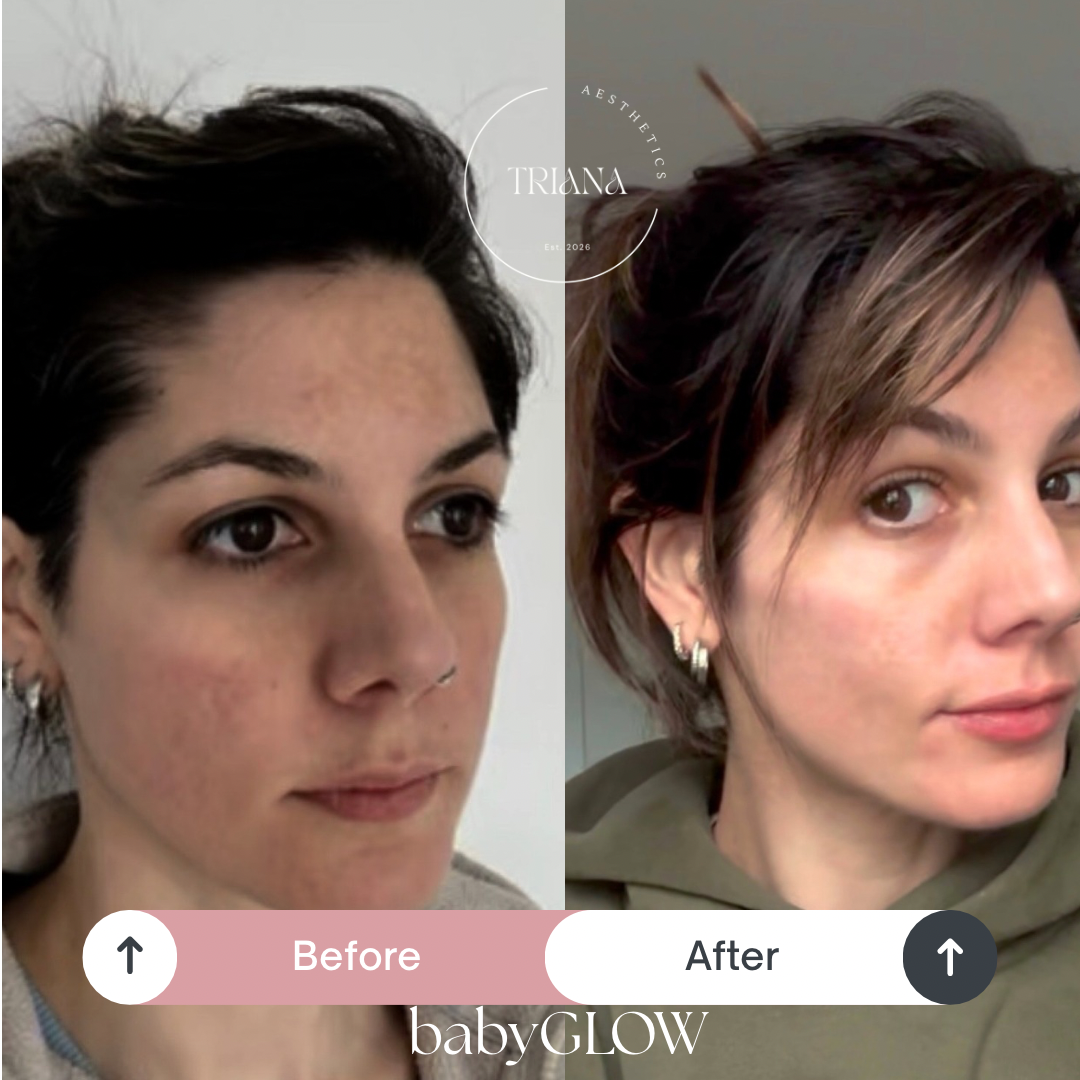 Before and after photos of a woman showing skin improvement, with text overlay indicating 'Before' and 'After' skincare treatment by babyGLOW.