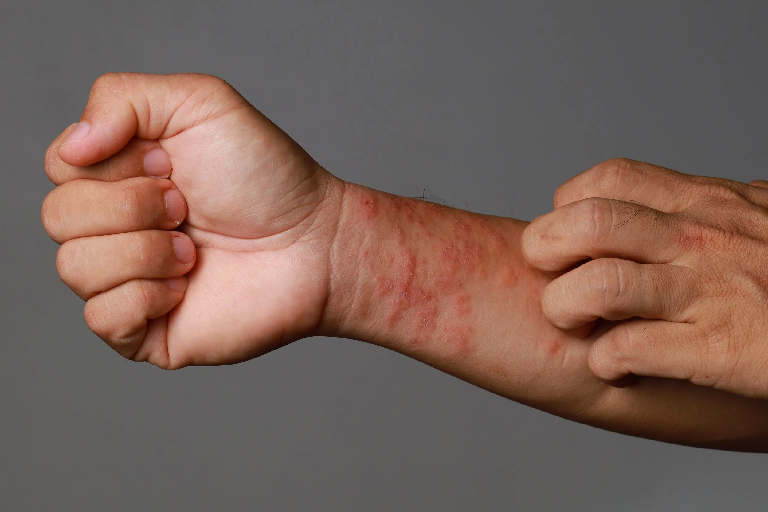 When Your Skin Keeps Flaring Up: Looking Beyond the Surface